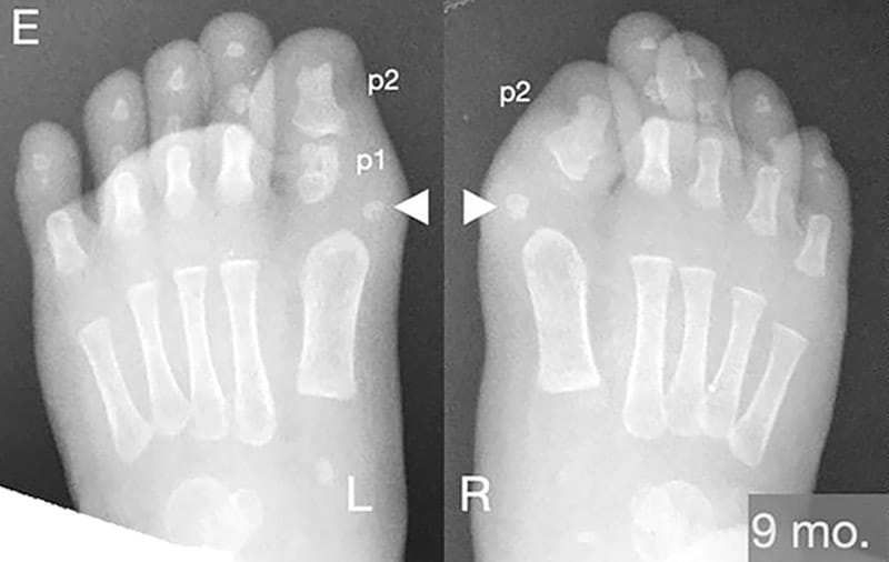 FOP great toe shows two developmental phenotypes
